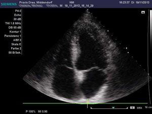 Herzultraschall aller vier Herzkammern